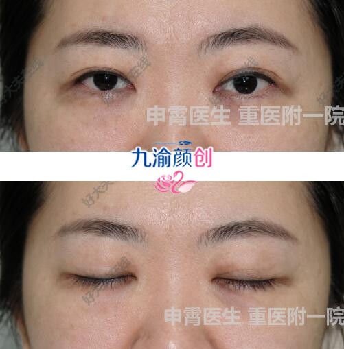 重医大附一院申霄双眼皮案例2例，价格便宜/效果自然